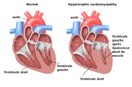 Effets de la HCM